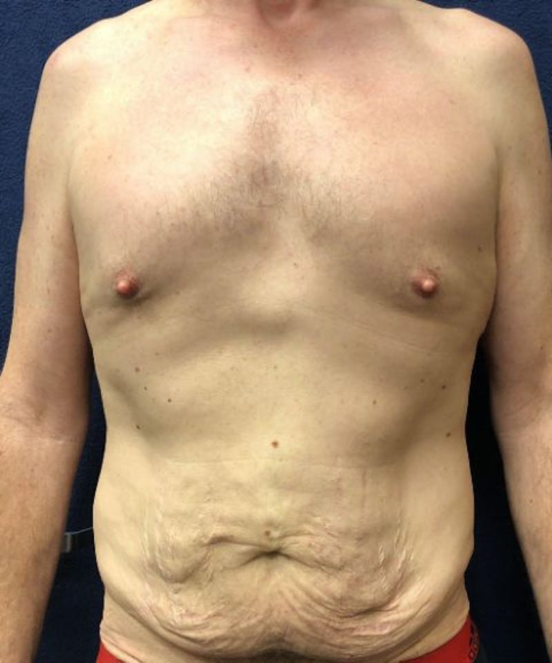 Powertuck Before & After Gallery - Patient 239148 - Image 1