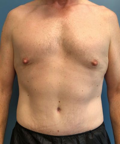 Powertuck Before & After Gallery - Patient 239148 - Image 2