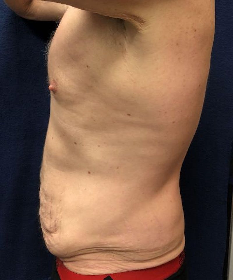 Powertuck Before & After Gallery - Patient 239148 - Image 3