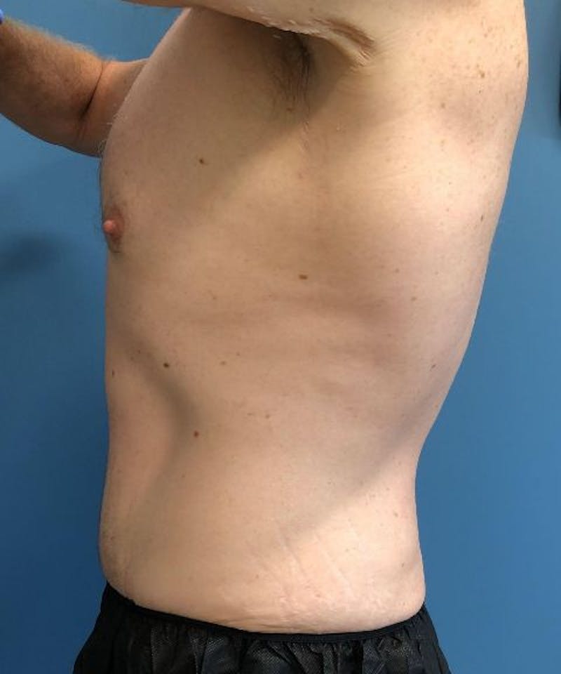 Powertuck Before & After Gallery - Patient 239148 - Image 4