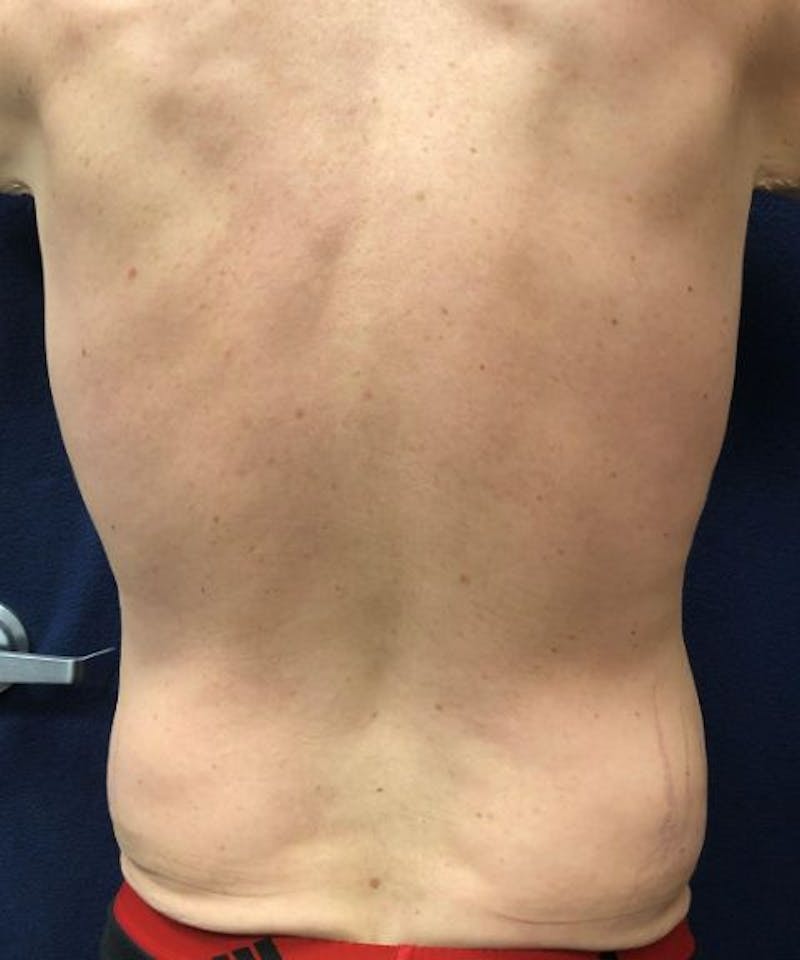 Powertuck Before & After Gallery - Patient 239148 - Image 5