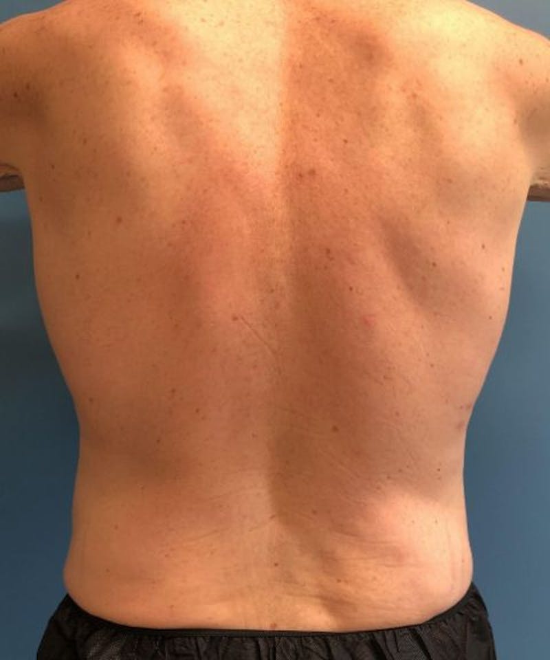 Powertuck Before & After Gallery - Patient 239148 - Image 6