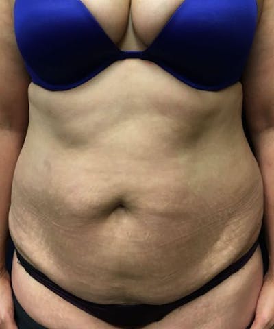 Powertuck Before & After Gallery - Patient 827774 - Image 1