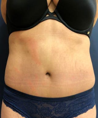 Powertuck Before & After Gallery - Patient 827774 - Image 2