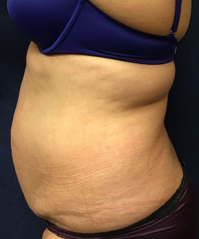Powertuck Before & After Gallery - Patient 827774 - Image 3