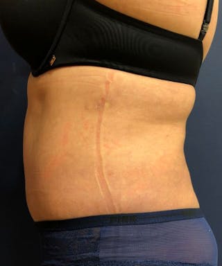 Powertuck Before & After Gallery - Patient 827774 - Image 4