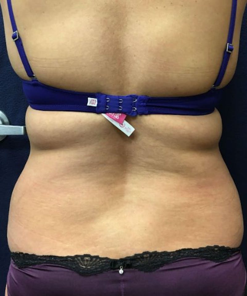 Powertuck Before & After Gallery - Patient 827774 - Image 5