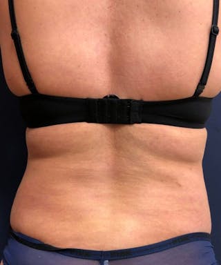 Powertuck Before & After Gallery - Patient 827774 - Image 6