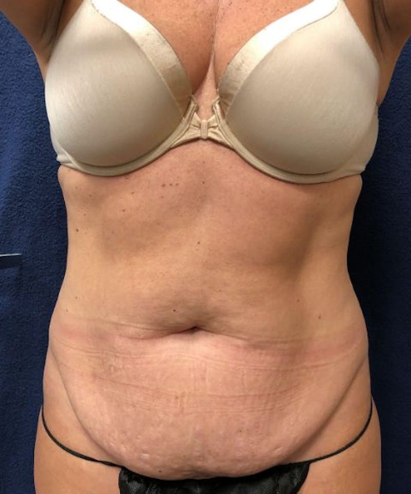 Powertuck Before & After Gallery - Patient 382172 - Image 1