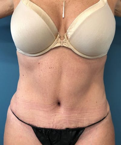 Powertuck Before & After Gallery - Patient 382172 - Image 2