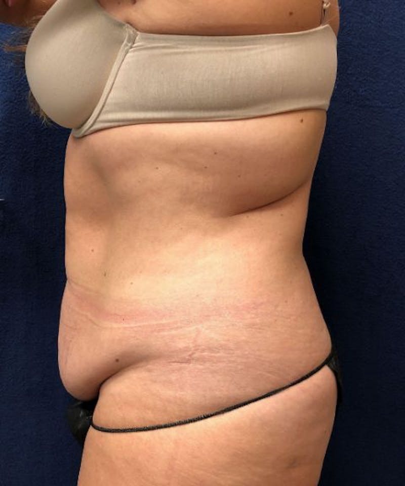 Powertuck Before & After Gallery - Patient 382172 - Image 3