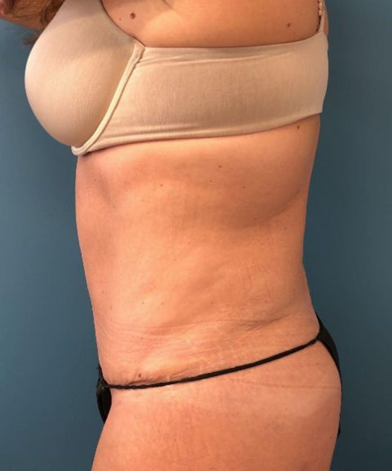 Powertuck Before & After Gallery - Patient 382172 - Image 4
