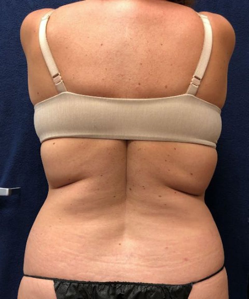 Powertuck Before & After Gallery - Patient 382172 - Image 5