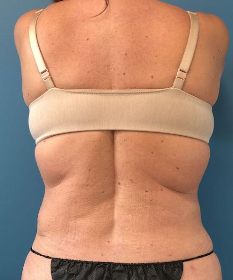 Powertuck Before & After Gallery - Patient 382172 - Image 6