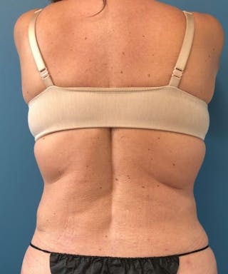 Powertuck Before & After Gallery - Patient 382172 - Image 6