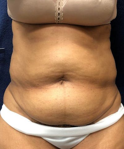 Powertuck Before & After Gallery - Patient 266168 - Image 1