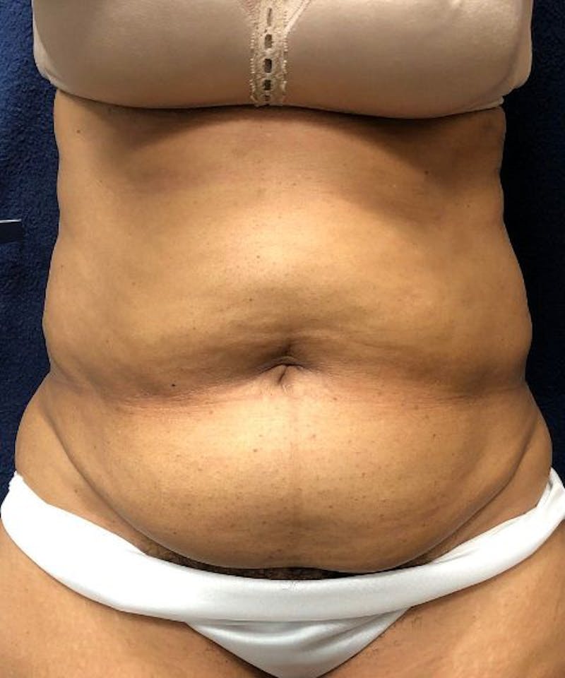 Powertuck Before & After Gallery - Patient 266168 - Image 1