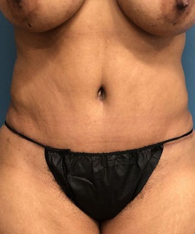 Powertuck Before & After Gallery - Patient 266168 - Image 2