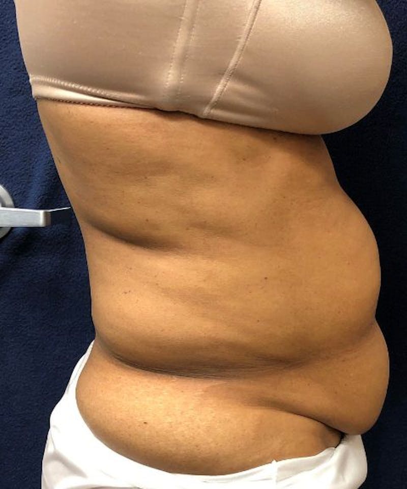 Powertuck Before & After Gallery - Patient 266168 - Image 3