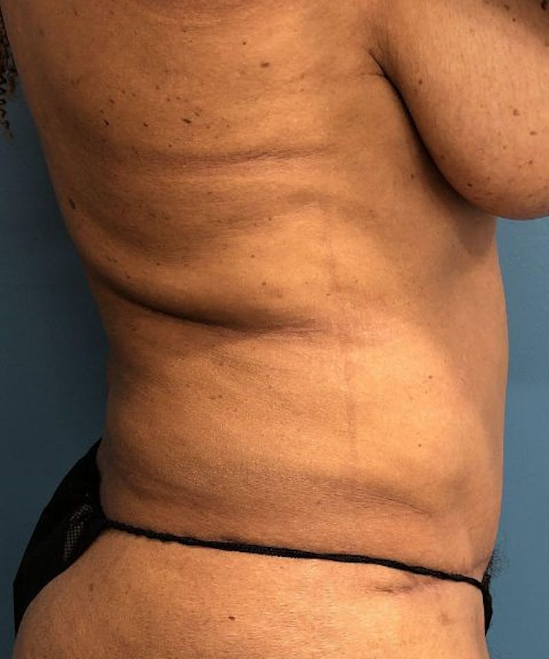 Powertuck Before & After Gallery - Patient 266168 - Image 4
