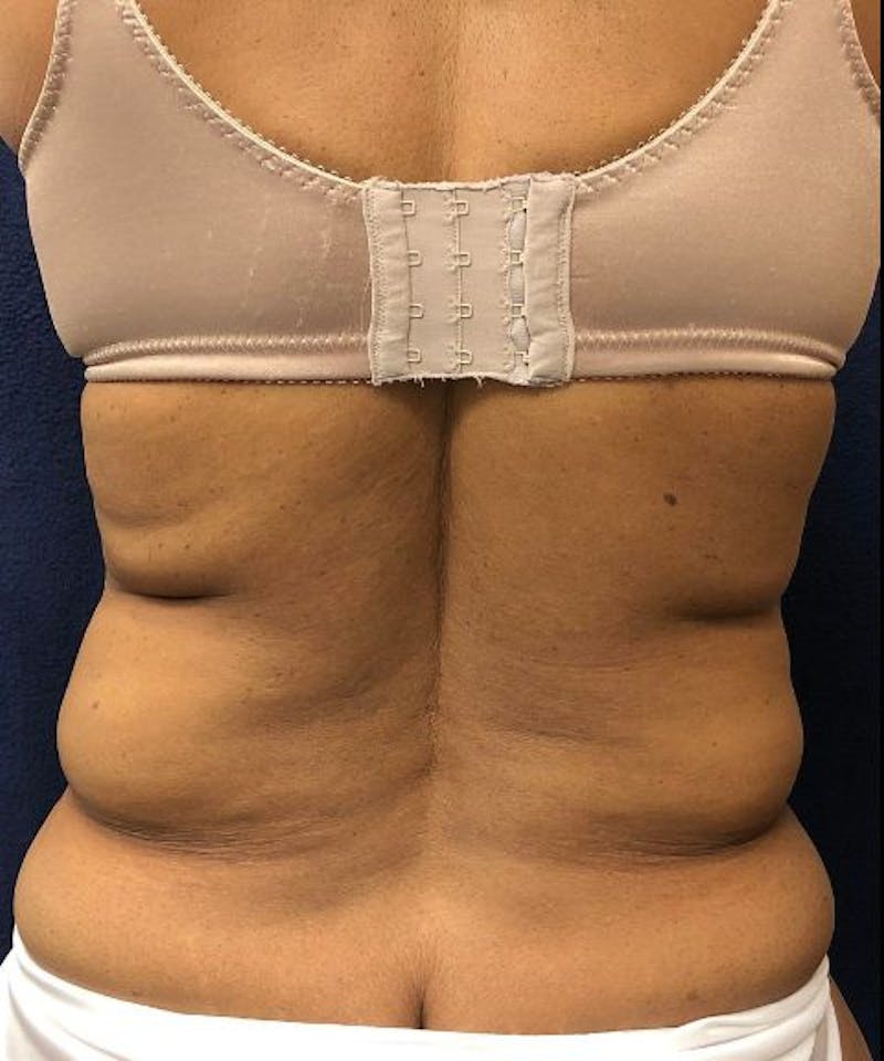 Powertuck Before & After Gallery - Patient 266168 - Image 5