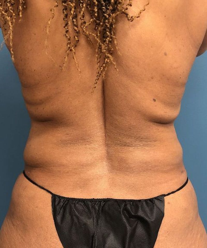 Powertuck Before & After Gallery - Patient 266168 - Image 6