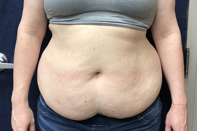 Powertuck Before & After Gallery - Patient 514992 - Image 1