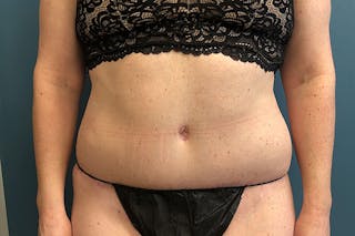 Powertuck Before & After Gallery - Patient 514992 - Image 2