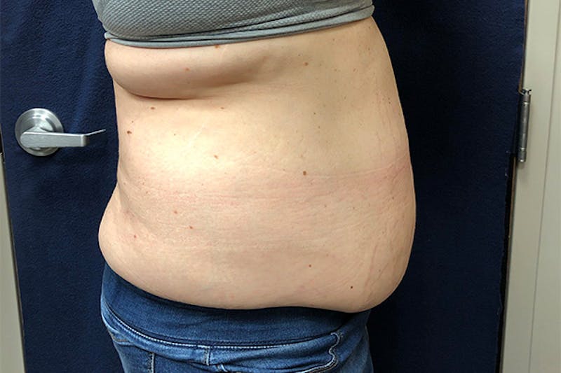 Powertuck Before & After Gallery - Patient 514992 - Image 3