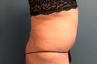 Powertuck Before & After Gallery - Patient 514992 - Image 4