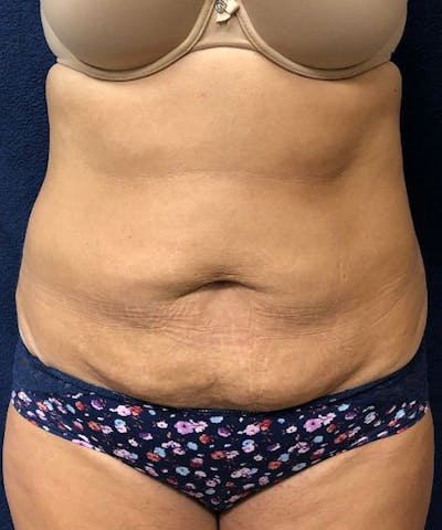 Powertuck Before & After Gallery - Patient 126015 - Image 1