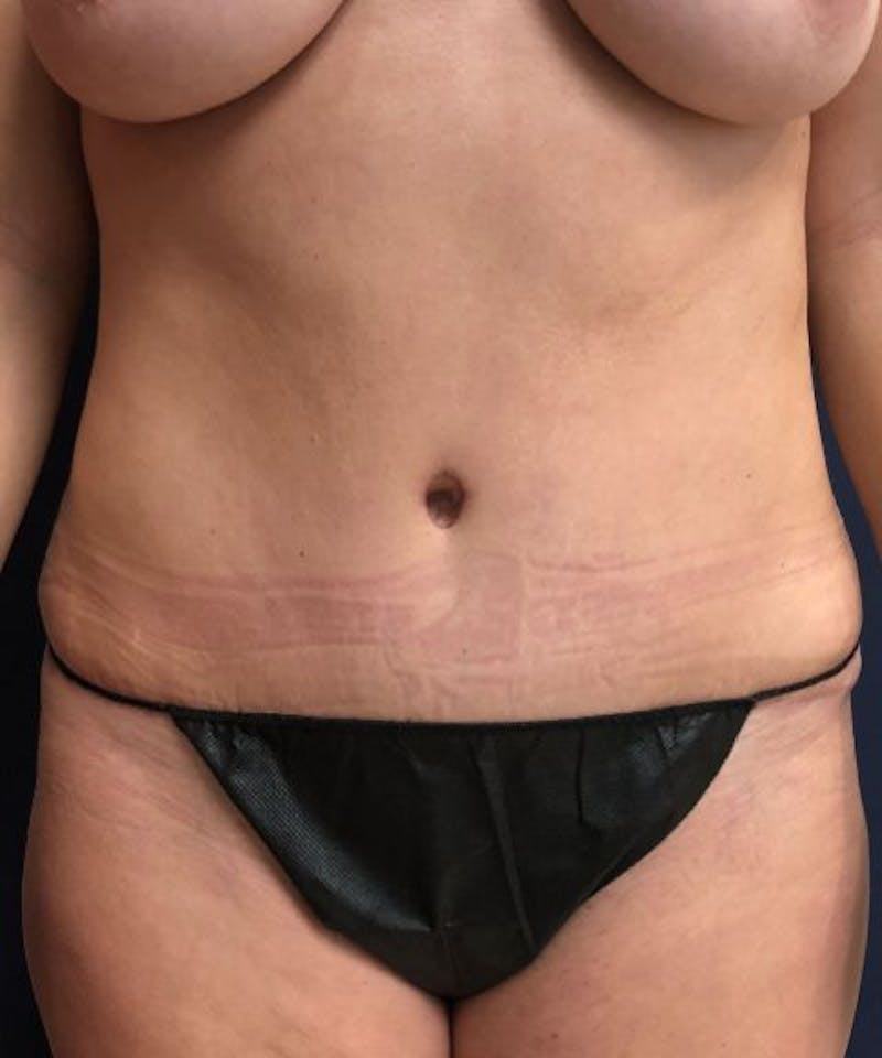 Powertuck Before & After Gallery - Patient 126015 - Image 2