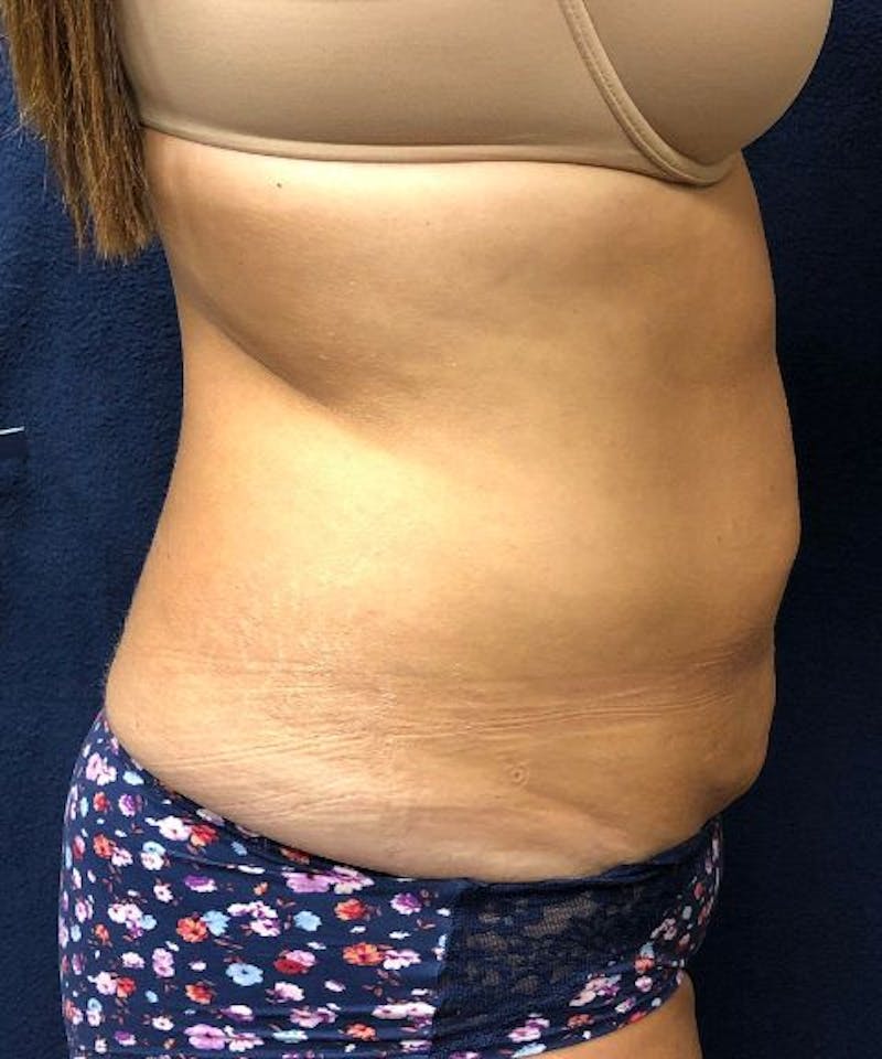 Powertuck Before & After Gallery - Patient 126015 - Image 3