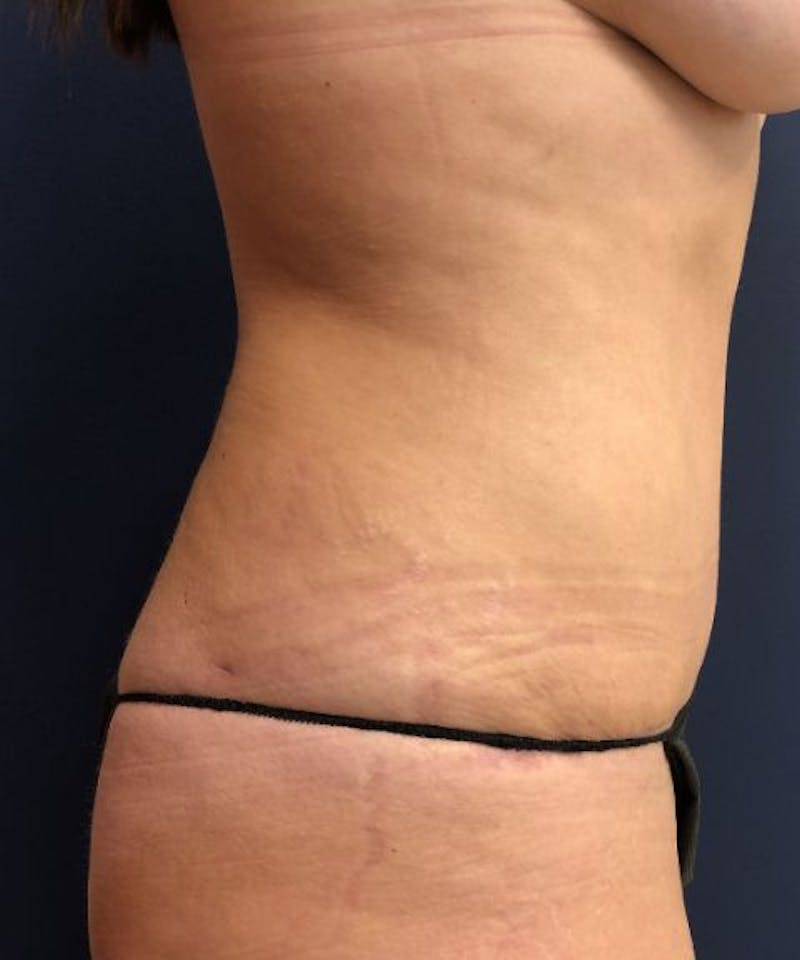 Powertuck Before & After Gallery - Patient 126015 - Image 4