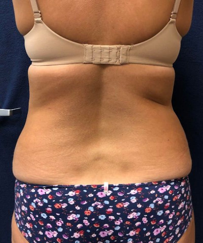 Powertuck Before & After Gallery - Patient 126015 - Image 5