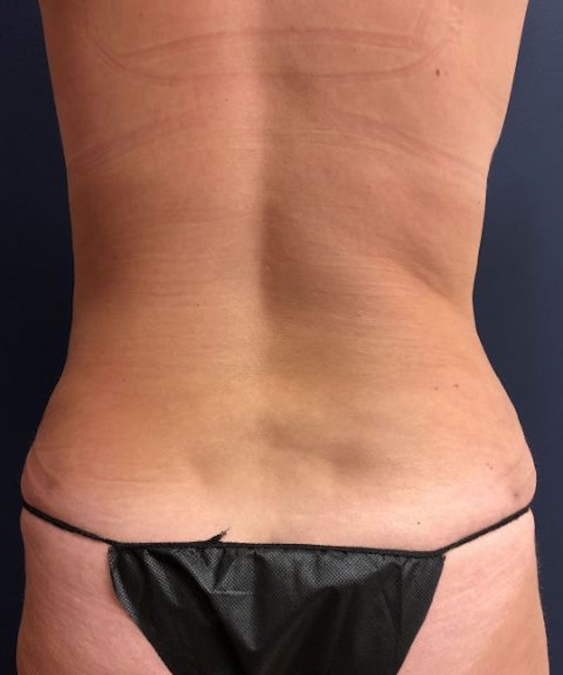 Powertuck Before & After Gallery - Patient 126015 - Image 6