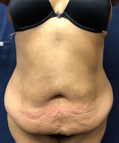 Powertuck Before & After Gallery - Patient 907829 - Image 1