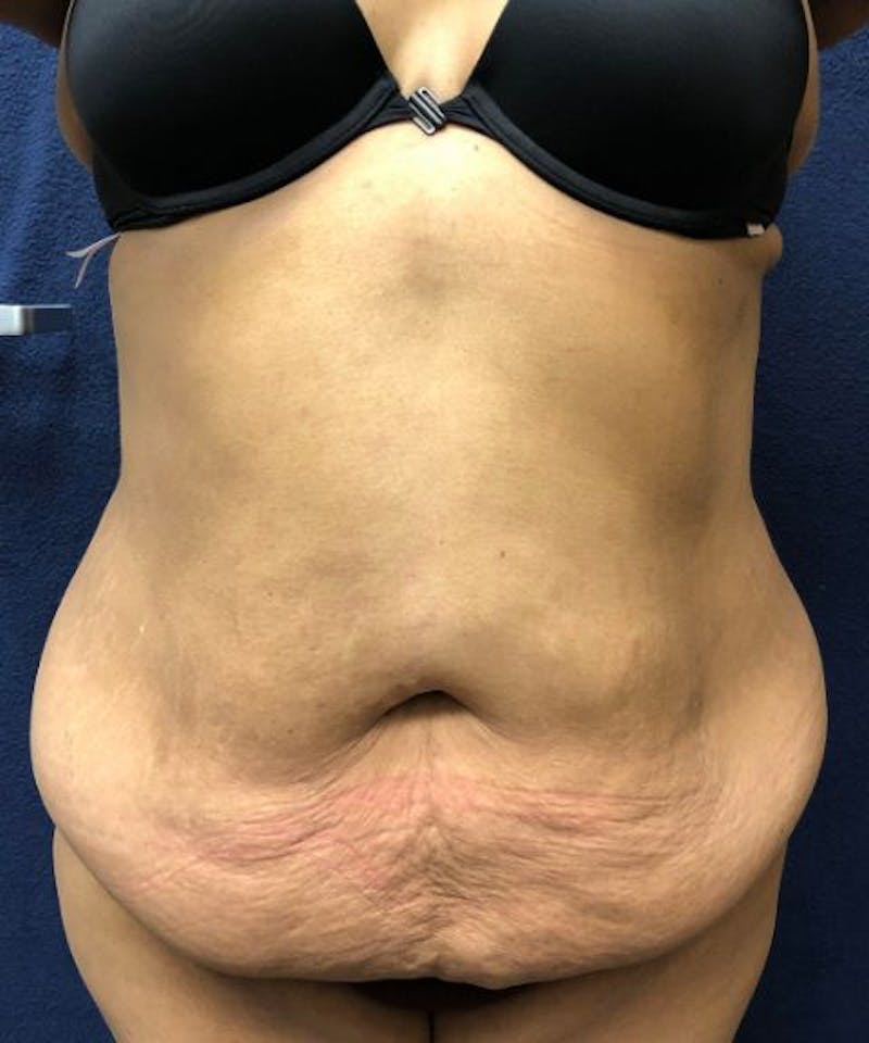 Powertuck Before & After Gallery - Patient 907829 - Image 1
