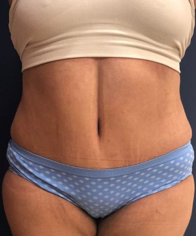 Powertuck Before & After Gallery - Patient 907829 - Image 2