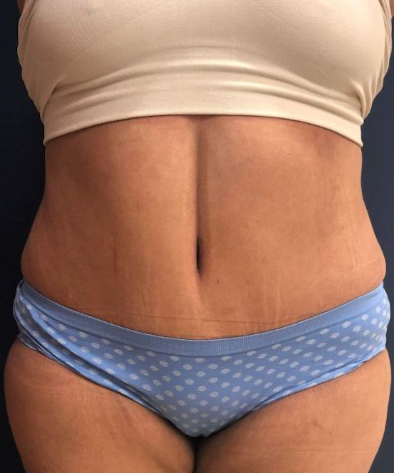 Powertuck Before & After Gallery - Patient 907829 - Image 2