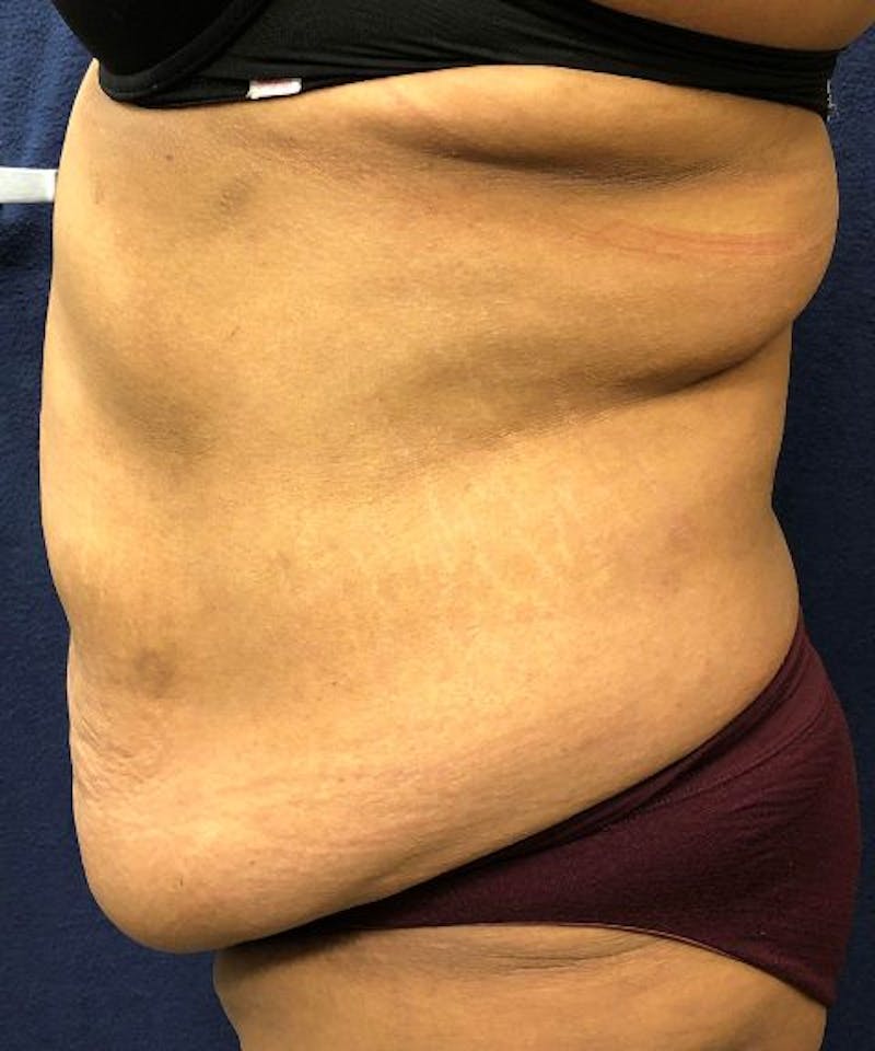 Powertuck Before & After Gallery - Patient 907829 - Image 3