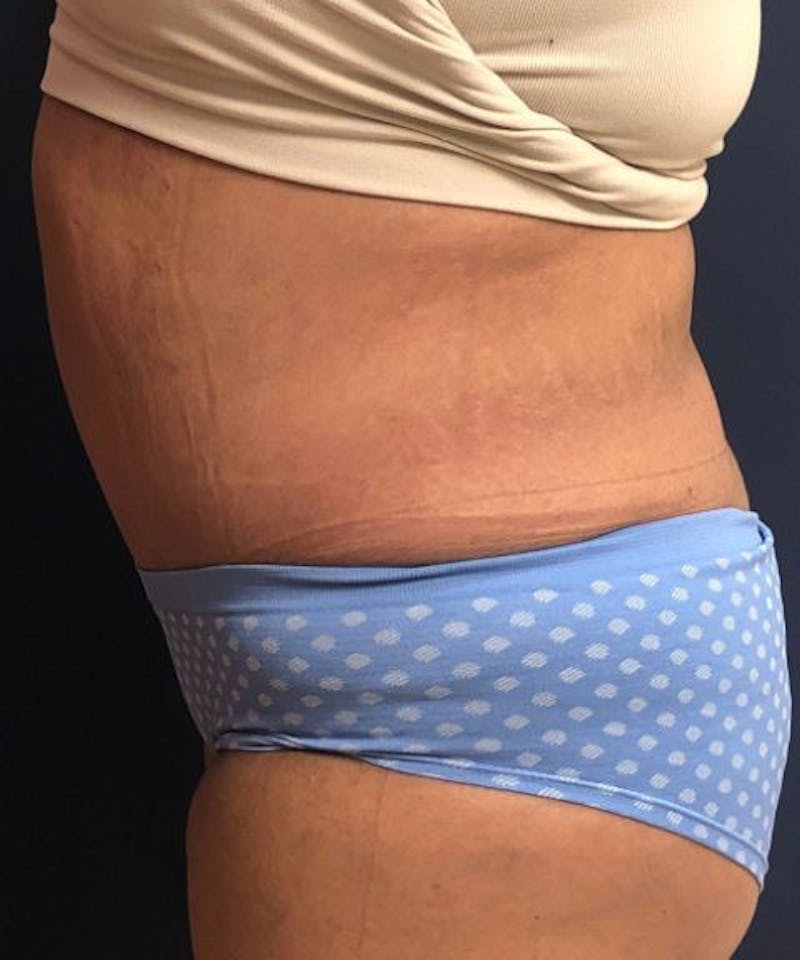 Powertuck Before & After Gallery - Patient 907829 - Image 4