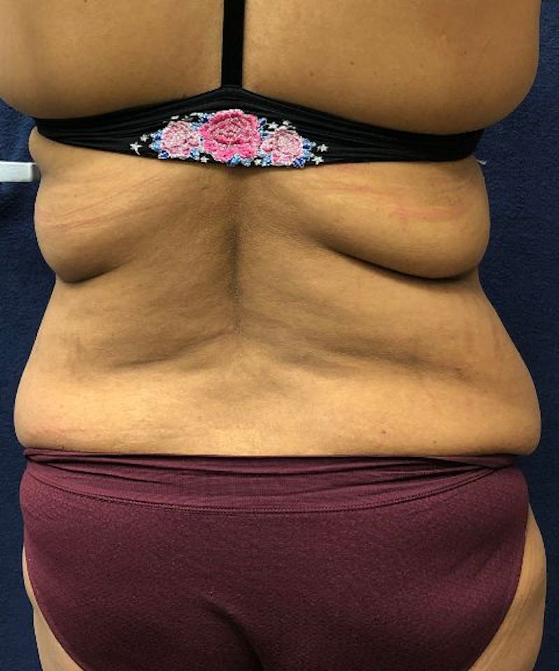 Powertuck Before & After Gallery - Patient 907829 - Image 5