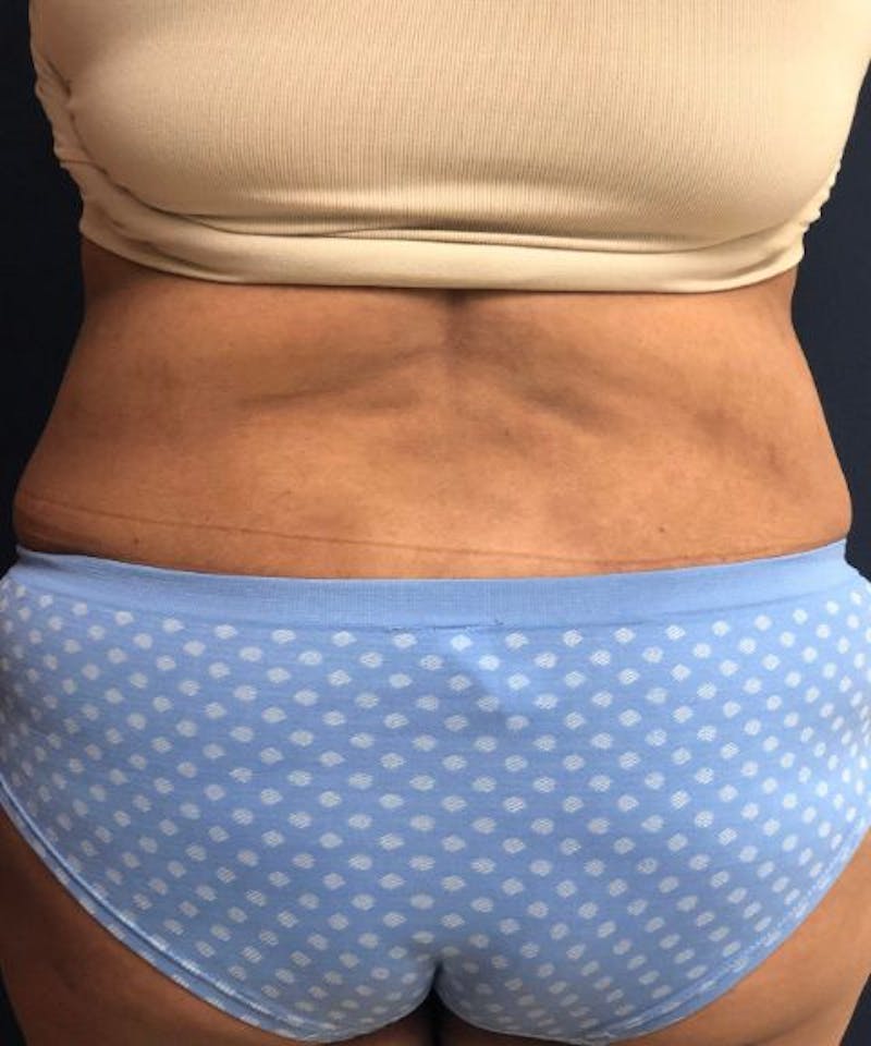 Powertuck Before & After Gallery - Patient 907829 - Image 6