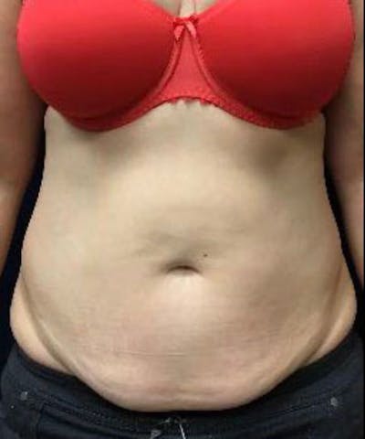 Powertuck Before & After Gallery - Patient 114287 - Image 1
