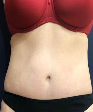 Powertuck Before & After Gallery - Patient 114287 - Image 2