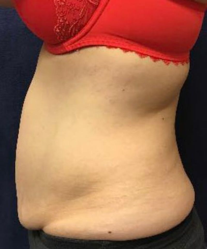 Powertuck Before & After Gallery - Patient 114287 - Image 3