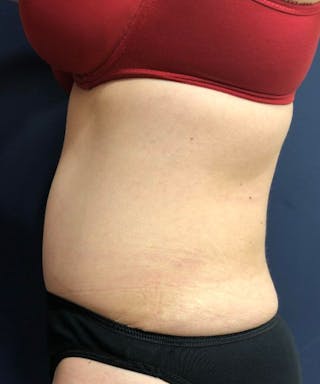 Powertuck Before & After Gallery - Patient 114287 - Image 4