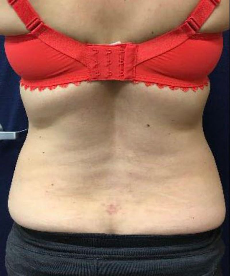 Powertuck Before & After Gallery - Patient 114287 - Image 5
