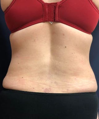 Powertuck Before & After Gallery - Patient 114287 - Image 6